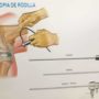Artroscopia de Rodilla